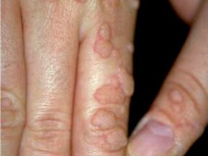 JYNS  AGZALARYNYŇ  PAPILLOMAWIRUS  ÝOKANÇLYKLARY