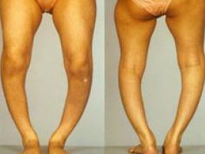 IGLILIK  KESELI,  ONY  BEJERMEK  WE  ÖŇÜNI  ALMAK