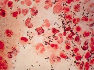 SÖZENEK  KESELINIŇ  ALAMATLARY  WE  KLINIKI  GÖRNÜŞLERI