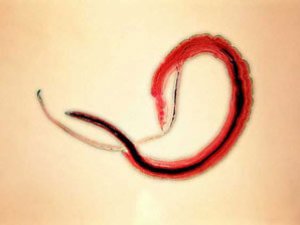 ISLENILMEDIK  "MYHMANLARYŇ"  KESELI: GELMINTOZ