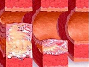 ATEROSKLEROZ:  SEBÄPLERI,  ALAMATLARY  WE  BEJERGISI