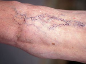 WENA DAMARLARYNYŇ WARIKOZ GIŇELMESI