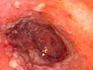 IÇEGÄNIŇ ADATY DÄL BAŞLY KESELI: ALAMATLARY WE BEJERGISI