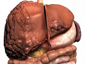 BAGRYŇ SIRROZY: GÖRNÜŞLERI, ALAMATLARY WE BEJERGI ÇÄRELERI