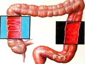 ENTEROKOLIT: SEPÄPLERI, ALAMATLARY WE BEJERGI ÇÄRELERI