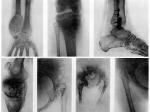 SÜŇK INÇEKESELI: ALAMATLARY WE BEJERGISI