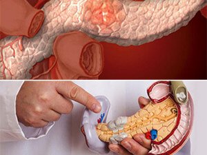 PANKREATIT: SEBÄPLERI, ALAMATLARY WE BEJERIŞ AÝRATYNLYKLARY