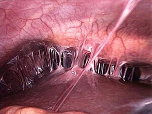 SEPLEŞME KESELI: SEBÄBI, ÝÜZE ÇYKYŞ ALAMATLARY, BEJERGISI