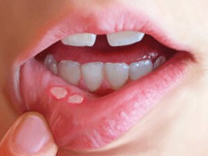STOMATIT: SEBÄPLERI, ALAMATLARY, BEJERGISI