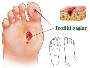 TROFIKI BAŞ KESELI: SEBÄPLERI, BEJERGISI