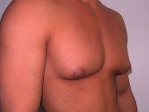 GINEKOMASTIÝA: SEBÄPLERI, ALAMATLARY, BEJERGI ÇÄRELERI