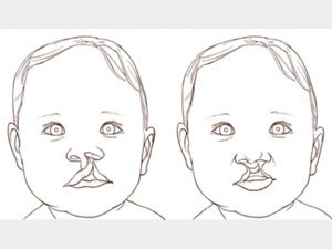 DOGA KEMÇILIKLER: TOWŞAN DODAK WE MÖJEK AGZY NÄMEDEN DÖREÝÄR?