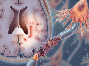 ÝAÝRAŇ SKLEROZ KESELI BARADA NÄMELERI BILMELI?