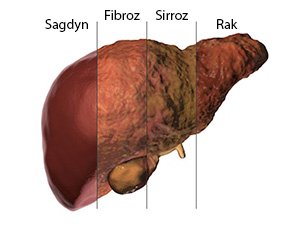 ÖÝKENIŇ FIBROZ KESELI NÄME?