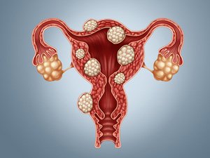 ÝATGYNYŇ MIOMASY, ÝUMURTGALYGYŇ KISTASY NÄHILI DÖREÝÄR? NÄDIP ÖŇÜNI ALMALY?