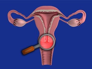 EROZIÝA ÖNELGESIZLIGE GETIRIP BILÝÄRMI?