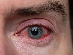 trachoma